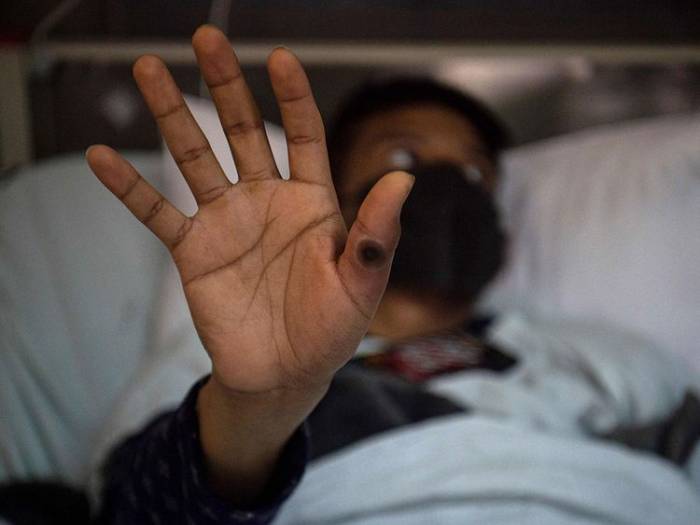 Pakistan starts screening all travelers for mpox virus 