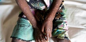 WHO declares mpox global health emergency 