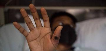 Pakistan starts screening all travelers for mpox virus 