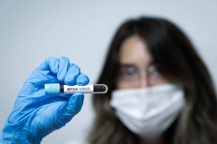 Jordan reports its first Mpox case 