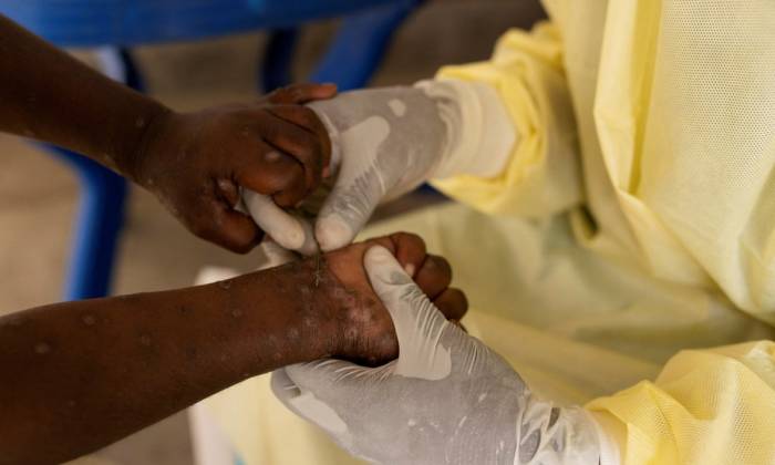 Over 100 Mpox-related deaths recorded in African countries 