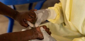 Over 100 Mpox-related deaths recorded in African countries 