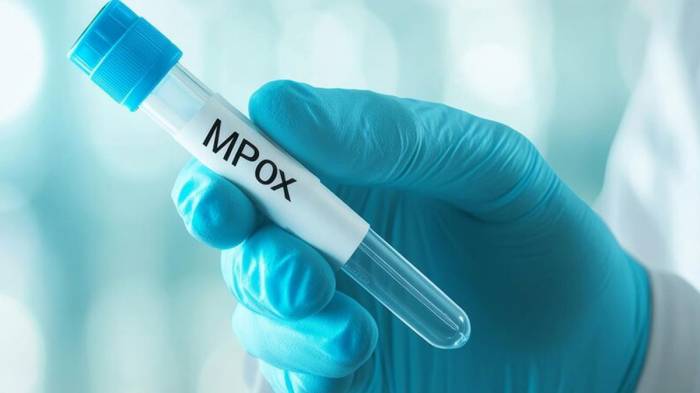 Zimbabwe records first two cases of mpox