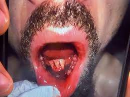 2024/10/1730016494.jpg + Robert Whittaker sustained a severe facial injury in his loss to Khamzat Chimaev at UFC 308 PHOTO News about - Robert Whittaker sustained a severe facial injury in his loss to Khamzat Chimaev at UFC 308 PHOTO