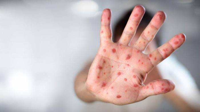 Canada sees surge in measles cases, highest in nine years