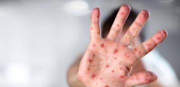 Canada sees surge in measles cases, highest in nine years