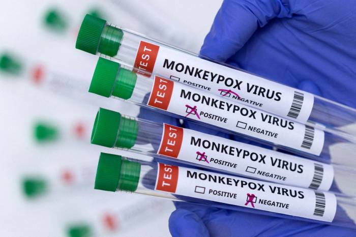 Azerbaijan confirms first monkeypox case 