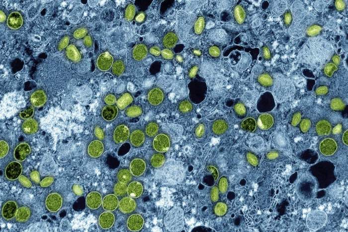 France reports first case of new mpox strain 