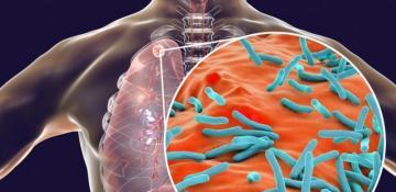 WHO warns funding cuts jeopardize progress against tuberculosis 