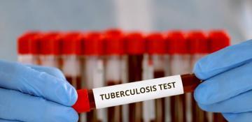 UK eyes new action plan to tackle rising tuberculosis 