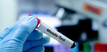 Canada's Ontario sees sharp surge in measles cases 