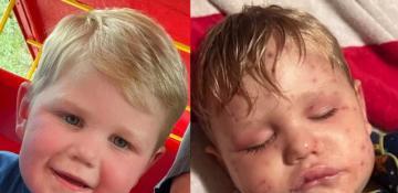 2-year-old toddler stung over 150 times by yellowjackets