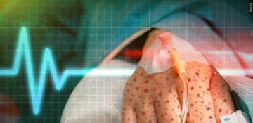 Measles outbreak that infected over 700 declared over in Texas