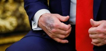 Trump seen with bruised right hand, fueling health speculations