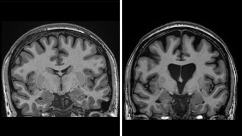 Huntington’s disease successfully treated for the first time