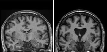 Huntington’s disease successfully treated for the first time