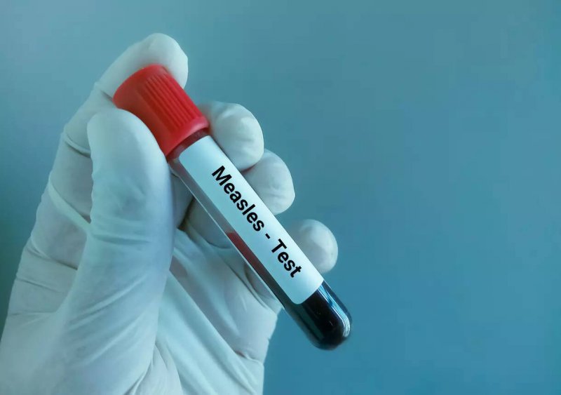 Measles warning issued in northern Sydney