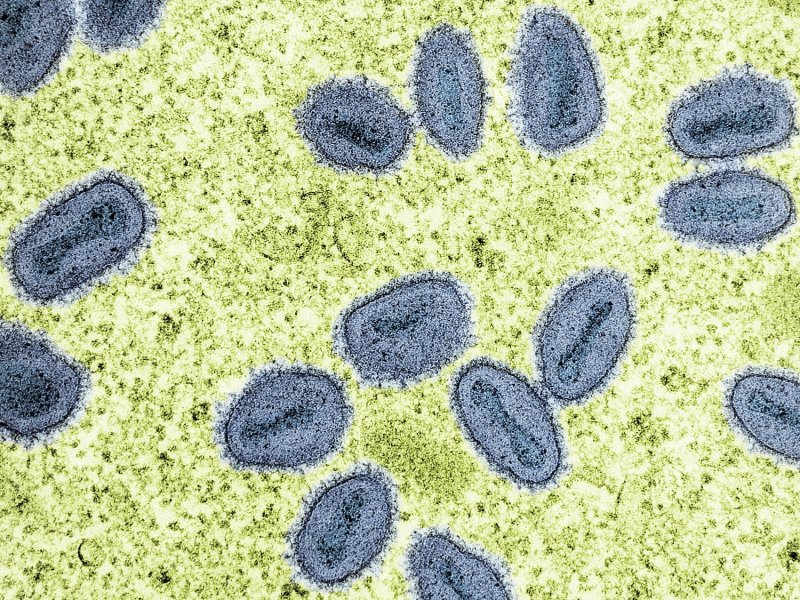 California confirms first US case of severe mpox strain with no travel history