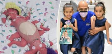 Texas twins once conjoined at the pelvis now cheerleaders 