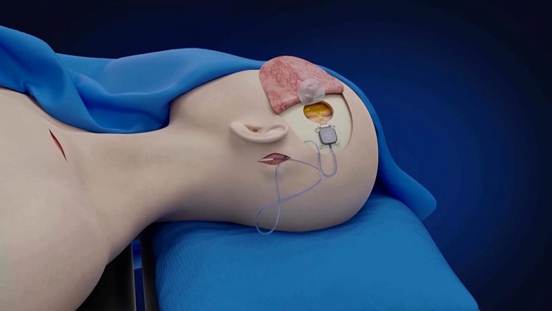 China brain implant lets paralyzed patient control devices 