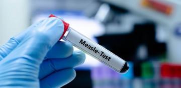 Measles outbreak risk in Sydney, health authorities warn