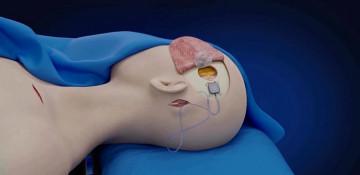 China brain implant lets paralyzed patient control devices 