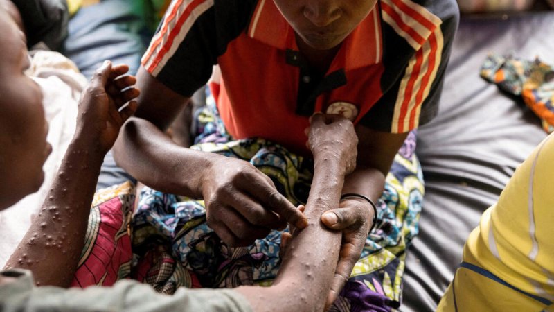 Zambia reports 367 mpox cases since October 2024 outbreak 