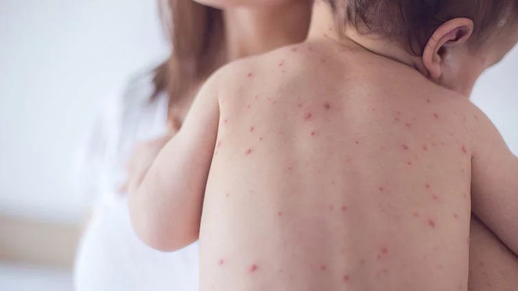 Measles outbreaks rise throughout the Americas 