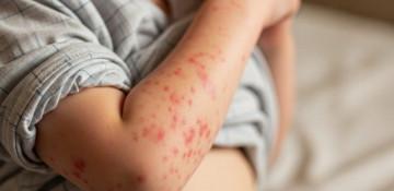 Bangladesh's measles-like outbreak kills 11 more, total deaths surpass 250