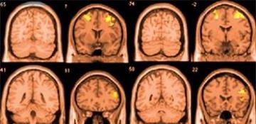 Massive study finds cannabis and tobacco use linked to shrinking brain size
