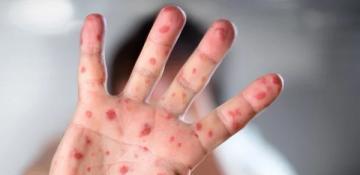 Eight more fatalities reported from measles and related symptoms in Dhaka, Bangladesh