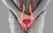The chronic approach to stopping bladder cancer recurrence