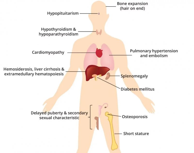 Study links Thalassemia to increased risk of reduced muscle function