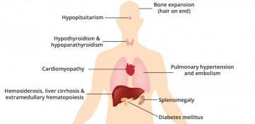 Study links Thalassemia to increased risk of reduced muscle function