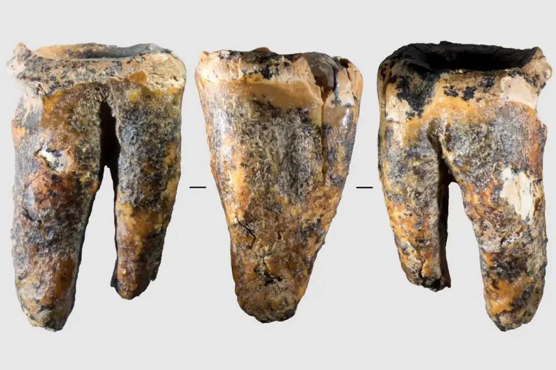Neanderthals drilled tooth to treat cavity, study finds