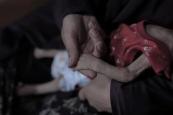 Doctors Without Borders warns of lasting harm to Gaza babies from malnutrition