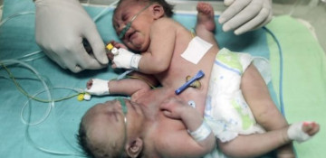 Gaza conjoined twins survive separation surgery