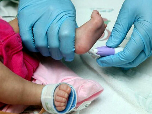 Heel test for newborns to be applied in Azerbaijan