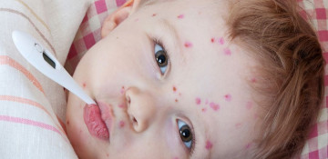 2385 people infected with measles in Georgia