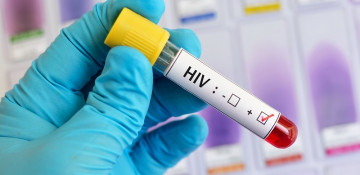 Highly virulent HIV variant discovered in Netherlands
