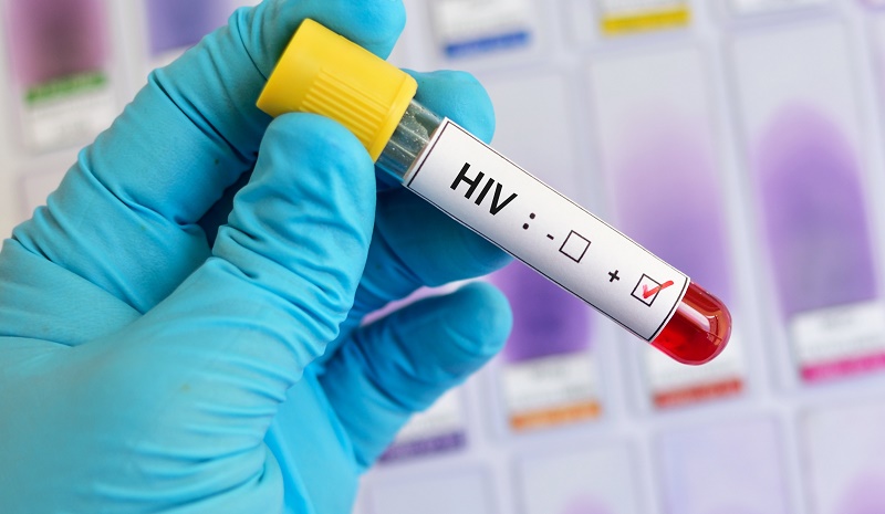 Highly virulent HIV variant discovered in Netherlands