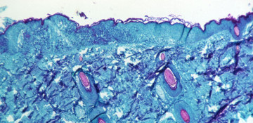 WHO calls emergency meeting as monkeypox cases cross 100 in Europe