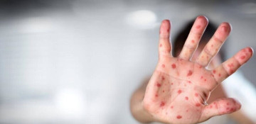 Iran records first case of monkeypox